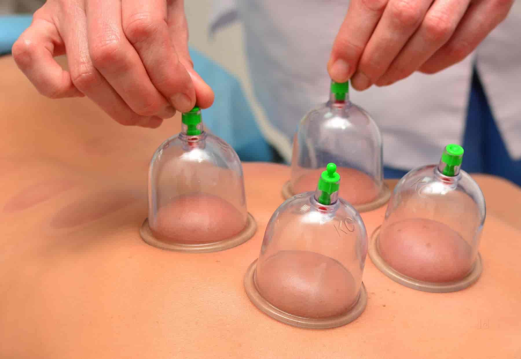 ACU - PLANET Acupuncture & Cupping Therapy Centre A.R Nagar