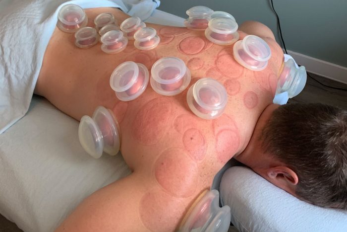 ACU - PLANET Acupuncture & Cupping Therapy Centre A.R Nagar